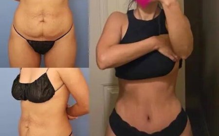 How to Choose the Best Tummy Tuck Surgeon in dubai for Your Transformation