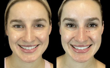 Natural-Looking Results: How the Best Doctors in dubai Approach Botox