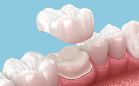 Transform Your Smile with Expert Dental Crowns Dubai