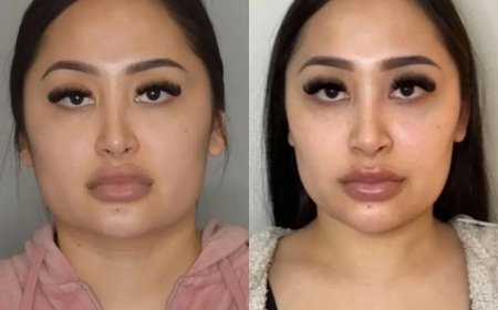 Global Recognition for the Best Buccal fat removal Surgeons in Dubai