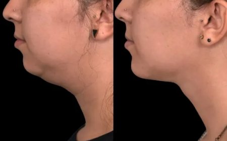 How to Find Certified Experts for Double chin removal in Dubai