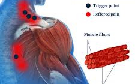 What Is Myofascial Pain? Causes, Symptoms, and Treatment Options