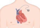 Brazil Cardiac Pacemakers Market Growth and Strategic Outlook 2025-2032