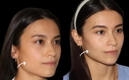 How Painful Are Sculptra Fillers in Dubai? Real Patients Answer