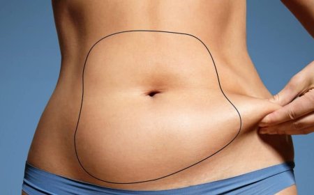 Post-Liposuction Recovery Top Tips from Best Liposuction Surgeons in Dubai