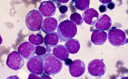 Acute Myeloid Leukemia (AML) Market Size, Trends, and Growth Forecast 2025-2032