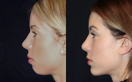 Best Aesthetic Clinic in dubai for Chin Fillers: Expert Advice for First-Timers