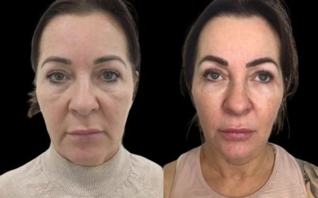 Profhilo vs Fillers: What the Best Aesthetic Clinic in Dubai Wants You to Know