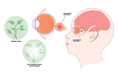 Neuromyelitis Optica Market Size, Trends, and Growth Forecast 2025-2032