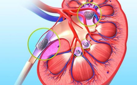 Advancements and Growth in Urinary Tract Obstruction Treatment Devices Market
