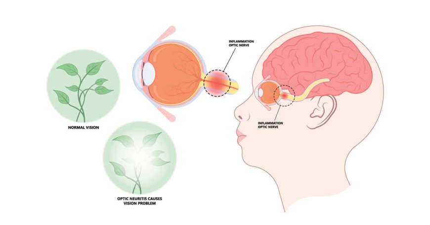 Neuromyelitis Optica Market Size, Trends, and Growth Forecast 2025-2032